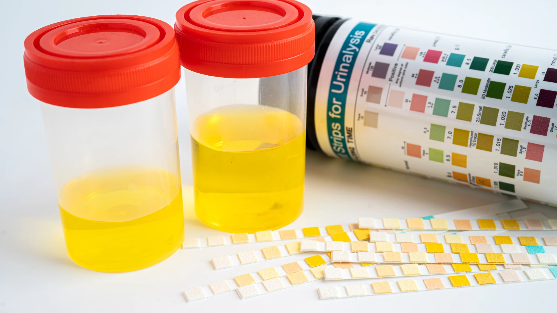 Complete Urinalysis